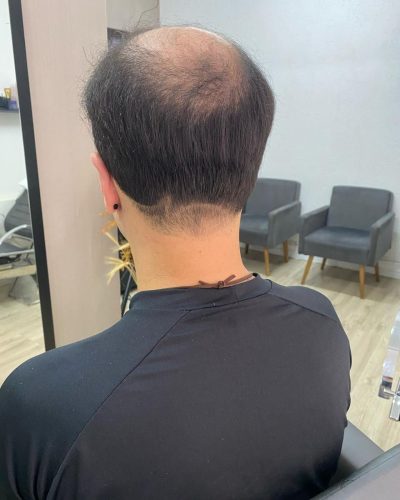Antes