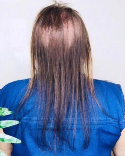 Antes